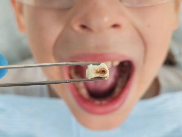 Best Emergency Root Canal Treatment in Knightstown, IN